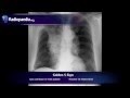 Golden S sign - radiology video tutorial (x-ray)