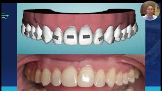Webinar Clips: Open Bite Case with Chair-side Refinement and Fine Tuning
