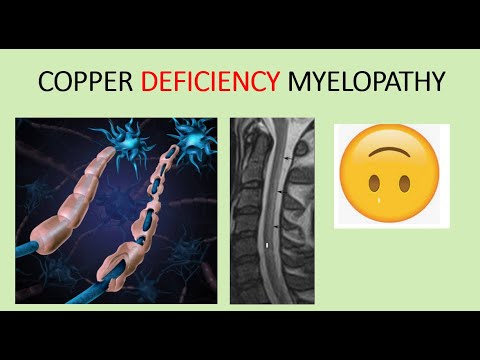Copper deficiency Myelopathy