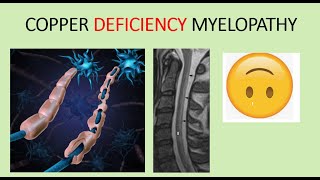 Copper deficiency Myelopathy