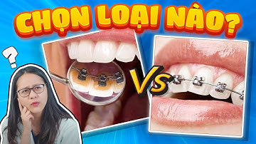 Niềng Răng Mặt Trong: 4 Tiêu Chí Đánh Giá Liệu Niềng Răng Mặt Trong Có Tốt Hơn Niềng Răng Mặt Ngoài?