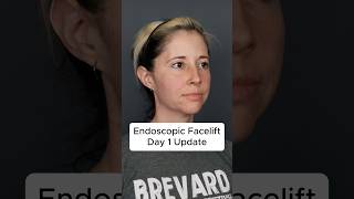 Endoscopic Deep Plane Facelift At 42 - Day 1 Update #facelift
