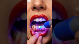 Gap Teeth Repair Transformation with AI