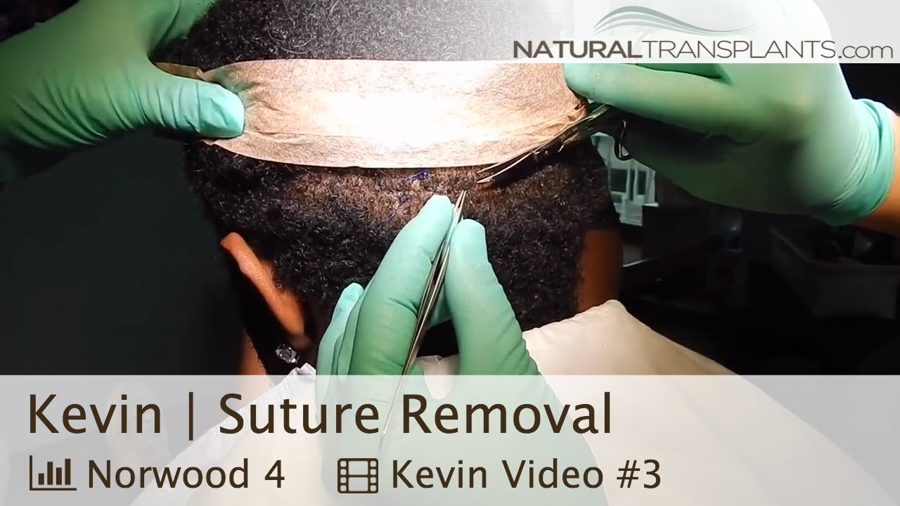 Hair Transplant Suture Removal Hair Transplant Scar (Kevin) YouTube