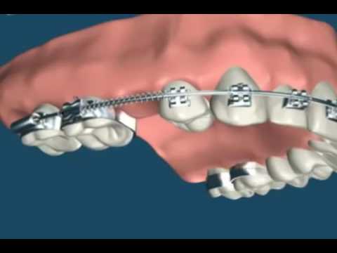 Ортодонтия  Брекеты  Выравнивание зубов
