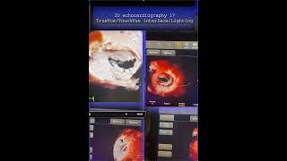 3D echocardiography 17/ TrueVue-TouchVue interface-:Lighting #echocardiography #cardiologytraining