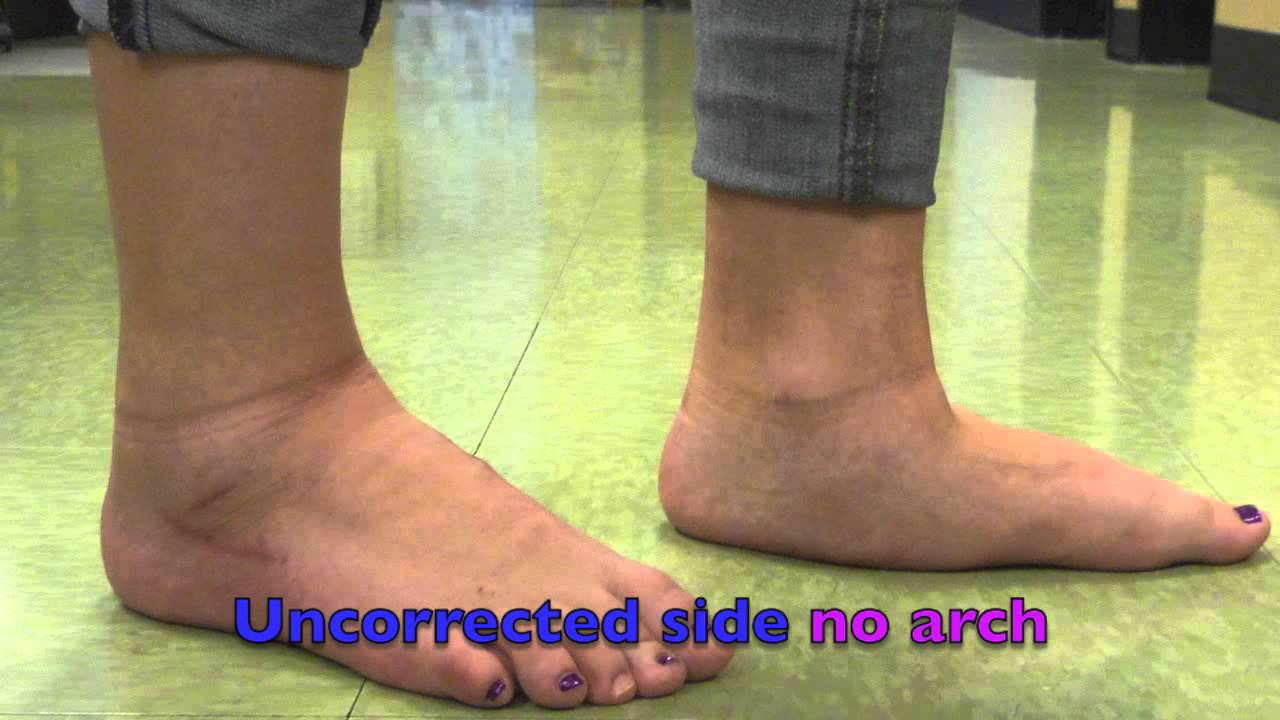 Lorelei Severe Flat Foot Correction by Dr. Peter Bregman - YouTube