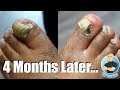 How To Get Rid Of Thick Toenails