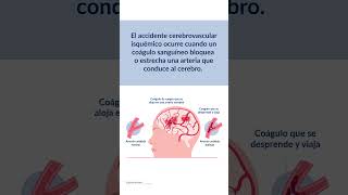 ¿Qué causa un accidente vascular cerebral?