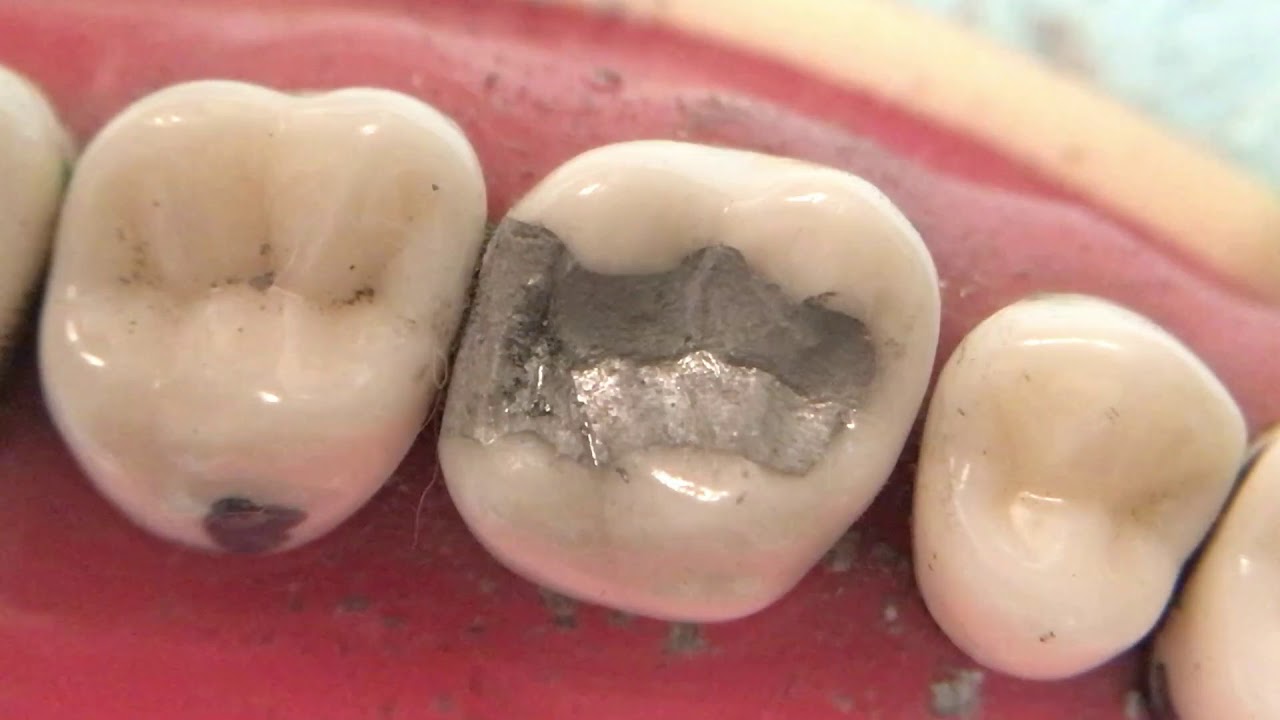 #3 DO Amalagam MR Carving 4 of 6