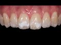 90 Day Dental Day 53- Steve Conteh - Icon Treatment for White Spots