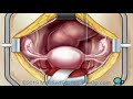 Preop hysterectomy removal of the uterus surgery