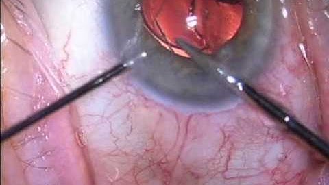 IOL Exchange (decentered Tecnis) by Steven G. Safran MD
