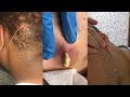 Satisfying pimples pop  cyst removal  acne  blackheads  pimple popping compilations 14