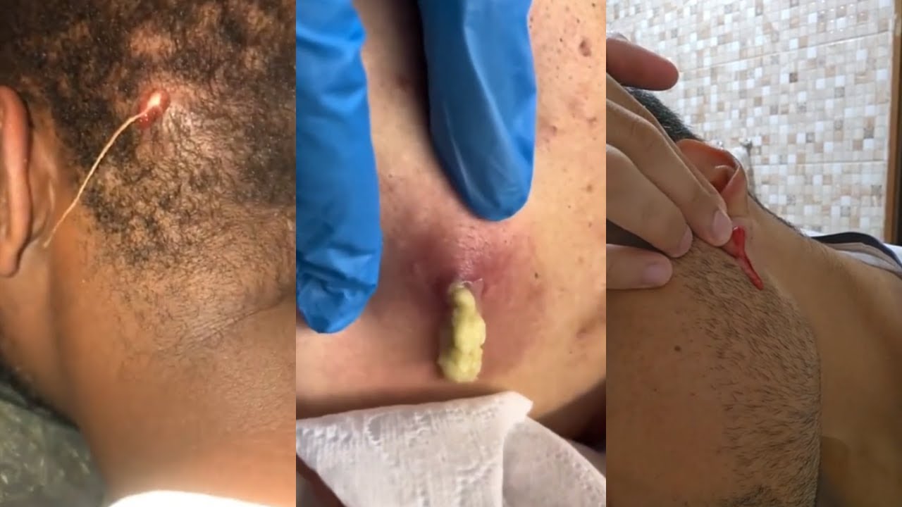 Satisfying Pimples Pop | Cyst Removal | Acne | Blackheads - Pimple Popping Compilation Videos #14