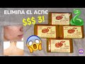 COMO ELIMINAR EL ACNE/ESPINILLAS | NADIA'S BEAUTY