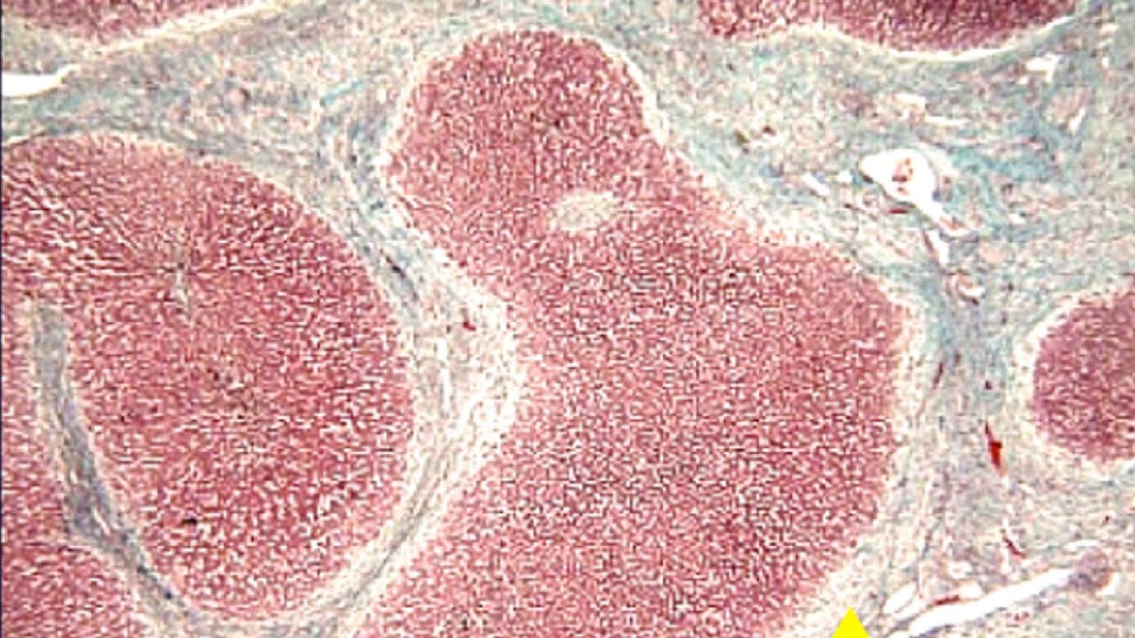 Conceptos básicos en cirrosis hepática: Ascitis I - Dr. Miguel Garassini