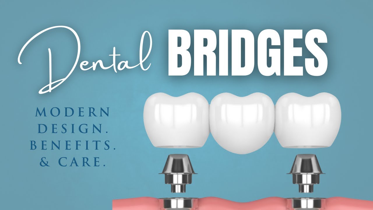 How Modern Dental Bridges Work