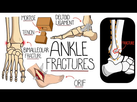 Ankle Fractures Made