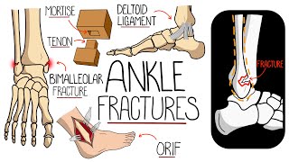 Ankle Fractures Made Easy screenshot 4