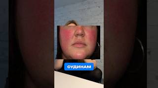 Купероз на обличчі: як гарячий душ руйнує судини #доглядзашкірою #купероз #косметолог