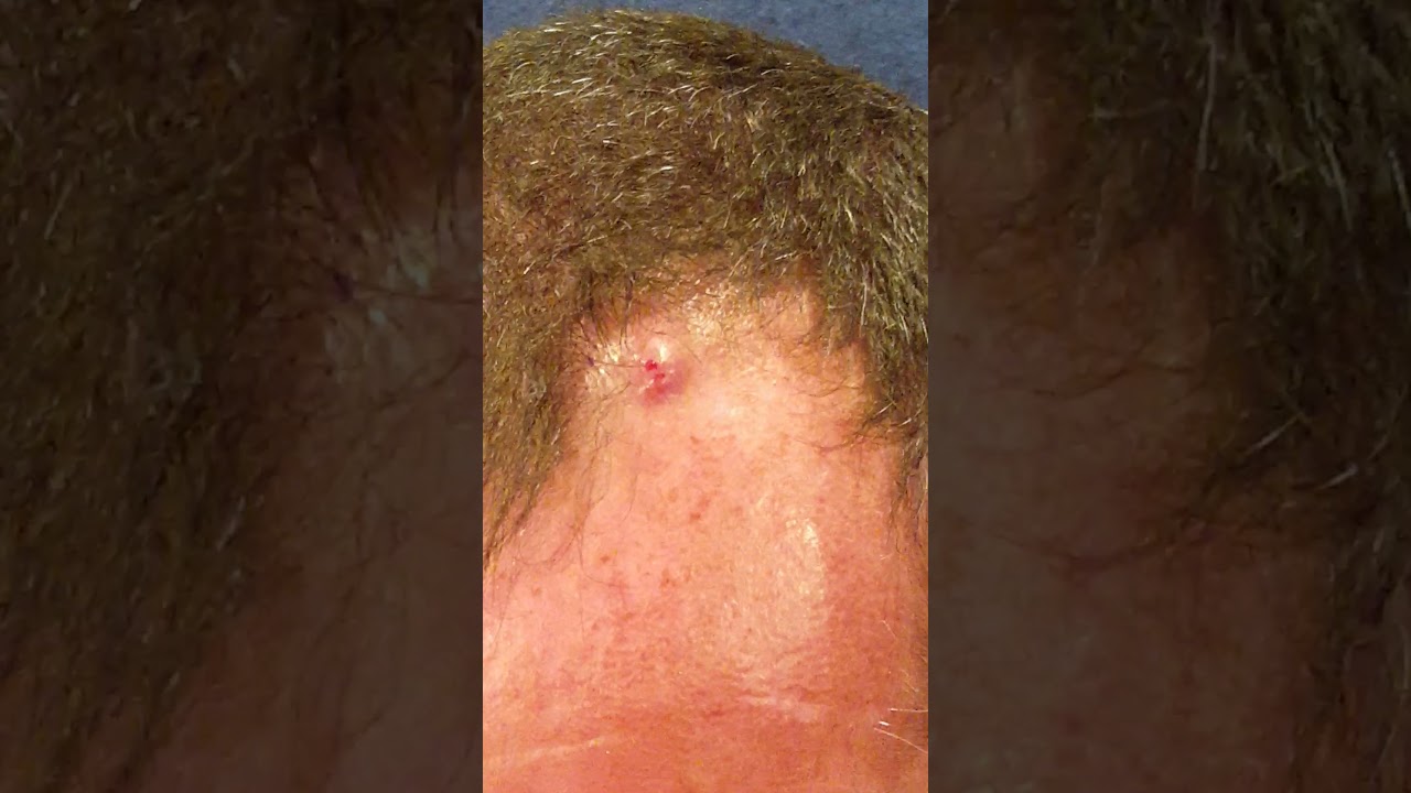 Cyst Explosion YouTube