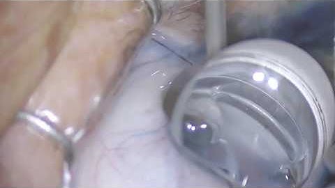 ISTENT Attempt- Cataract 1