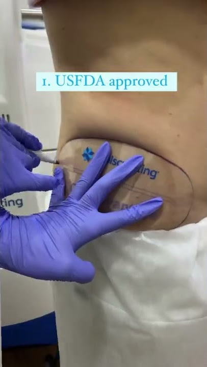 Say goodbye to love handles with Coolsculpting