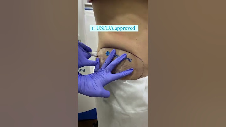 Say goodbye to love handles with Coolsculpting