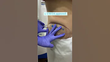 Say Goodbye To Love Handles With Coolsculpting 