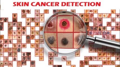 Skin cancer detection and classification using machine learning | MATLAB