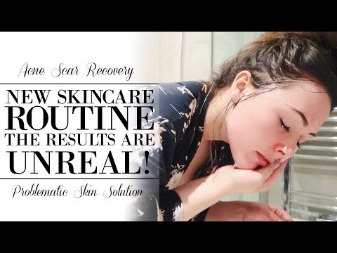 MY ACNE SCARS ARE DISAPPEARING! | SKIN CARE ROUTINE FOR ACNE PRONE SKIN