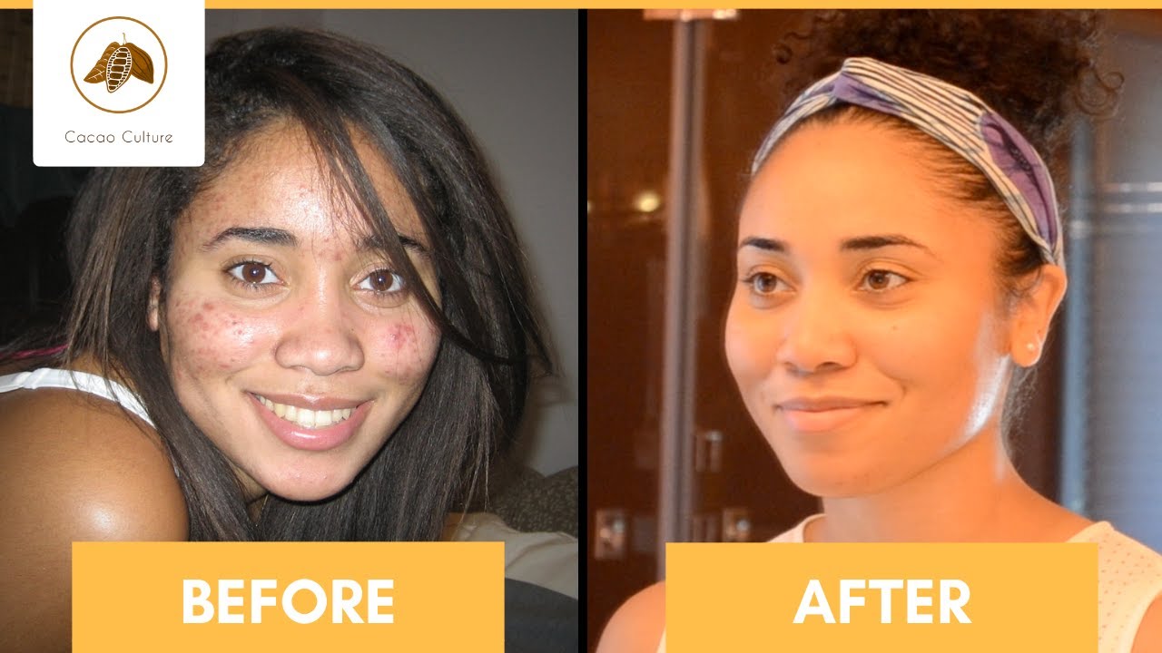 How to Get Clear Skin Naturally | Acne Treatment | Natural Remedy - YouTube