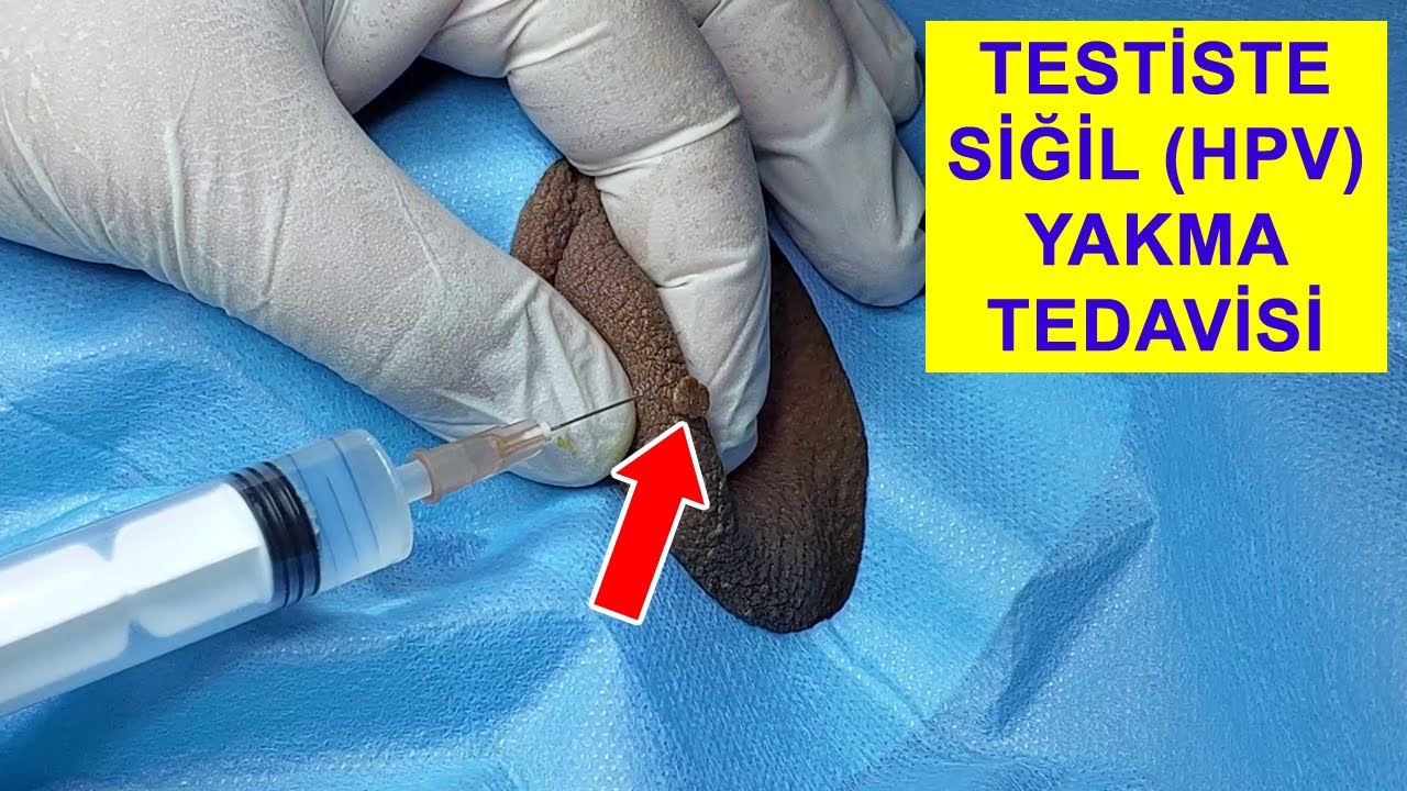 Testiste Genital Siğil (Kondilom/HPV) Yakma Tedavisi - Bilgi ve Randevu ...