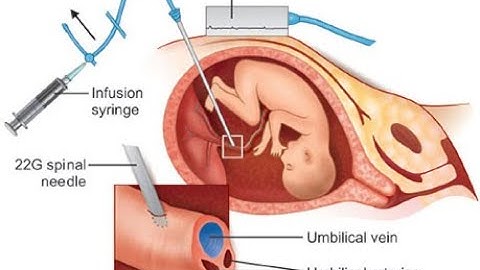 Fetal Blood Transfusion  CPT code - simplify medical coding