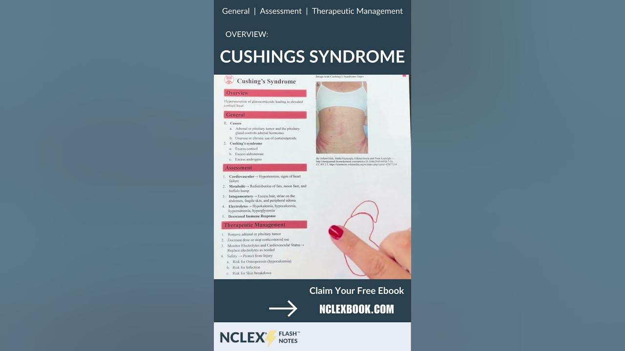 Cushing's Syndrome Overview for Nursing Students shorts NCLEX nursingschool nursing 