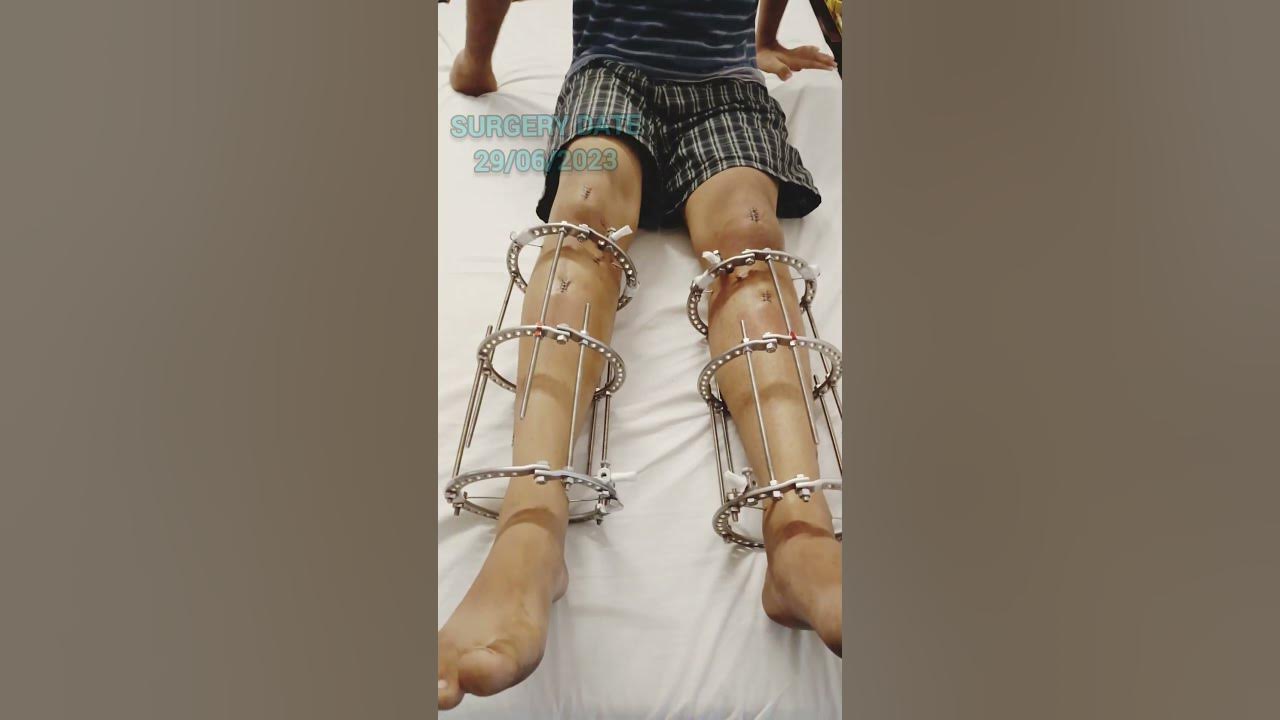 height-increase-surgery-limb-lengthening-surgery-in-india-height