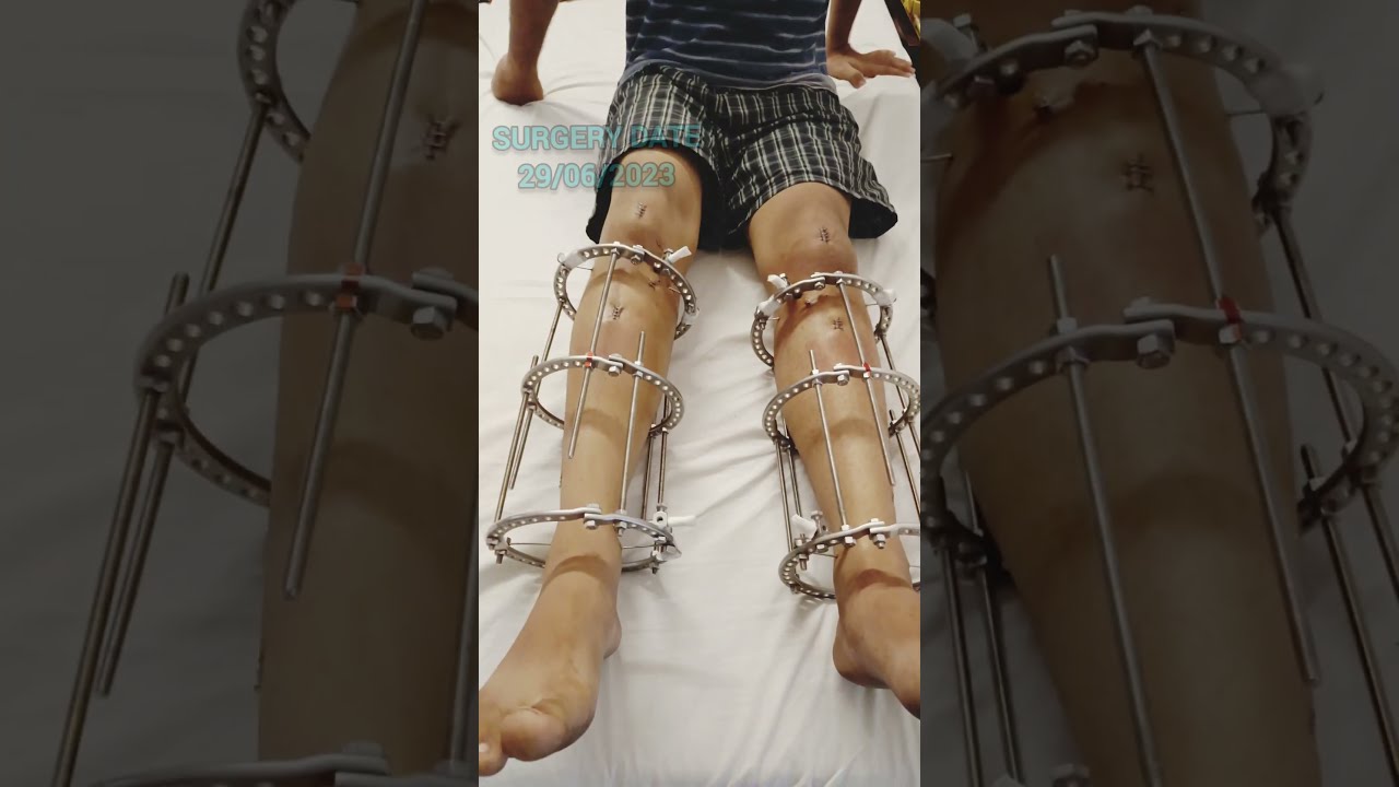 Height Increase Surgery Limb Lengthening Surgery In India Height Height Increase Surgery Limb Lengthening Surgery In India Height