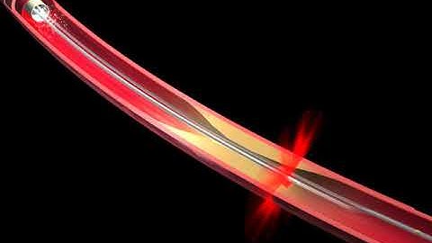 Fractional Flow Reserve