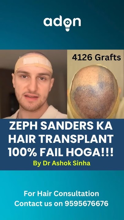 zeph-sanders-ka-hair-transplant-fail-kyon-hoga-hair-regrowth-hair