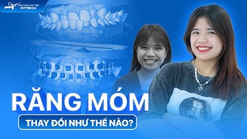 Cận Cảnh Quá Trình Răng Móm - Cắn Ngược Thay Đổi Sau 15 Tháng Với Công Nghệ X-Matrix