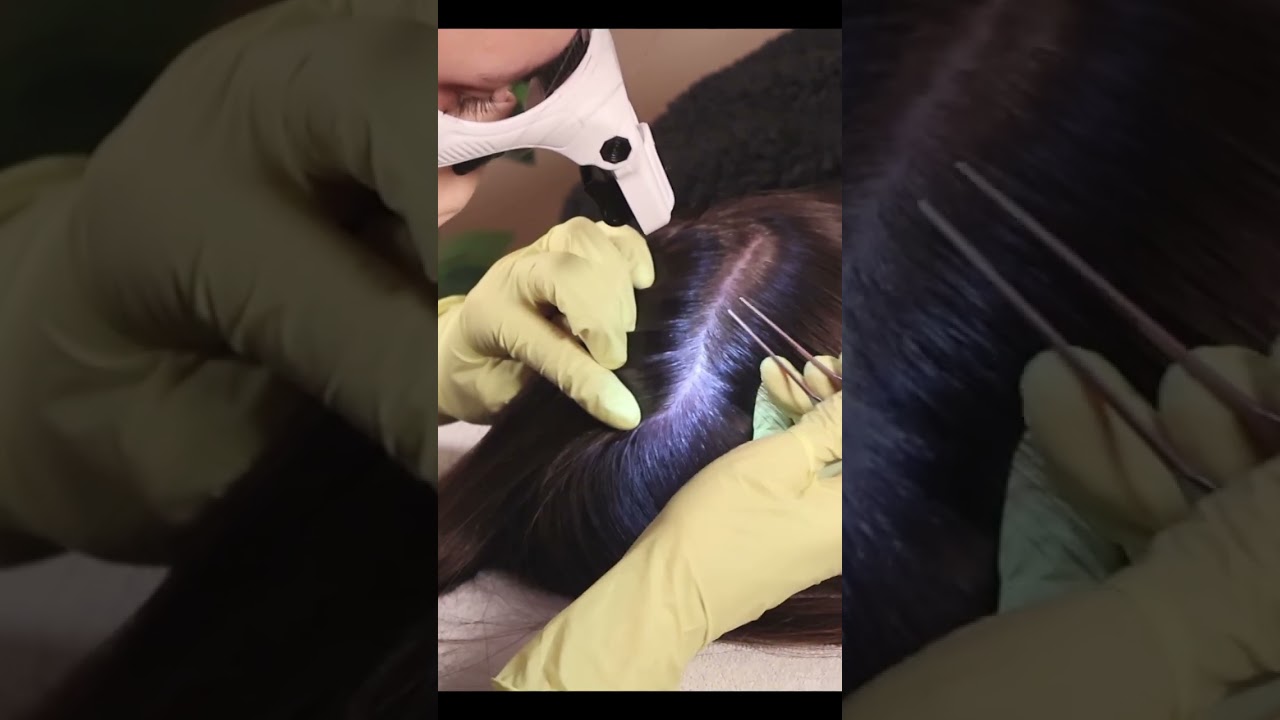 ASMR School Nurse LICE Check on SCALP | Lices Removal, Detailed Exam & Scratching 