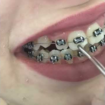 Difference between normal and ankylosed tooth sound || clinically dullsound || worldwidedentist||