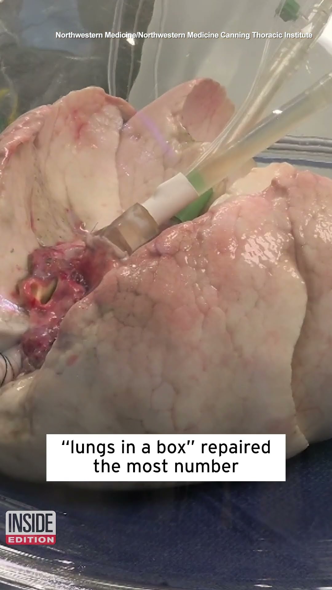 Hospital Puts Lungs in a Box #shorts