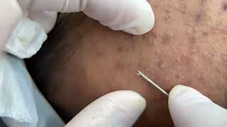 Blackheads & Whiteheads Extraction #blackheadremoval