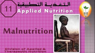 Applied Nutrition (11) Pediatric nutrition – Malnutrition تغذية الأطفال – سوء التغذية وكيفية علاجه