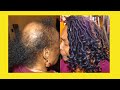 (ALOPECIA CROCHETS LOCS) EVERYTHING You Need To KNOW: About INSTALLATION!