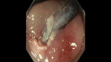 Colonoscopy with Polypectomy (EMR)