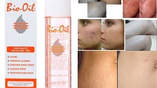 تجربتي مع / Review - My experience with \ BIO OIL