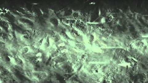 Atherosclerosis:  primary monocyte adhesion to coronary artery endothelium under shear flow